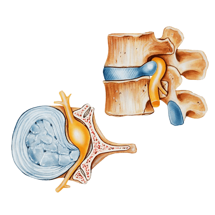 herniated disc illustration