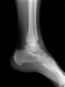 Xray of ankle