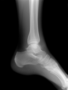 Ankle Xray