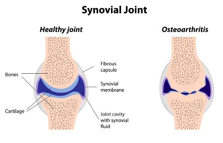 osteoarthritism