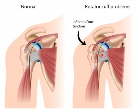 shoulder-impingement